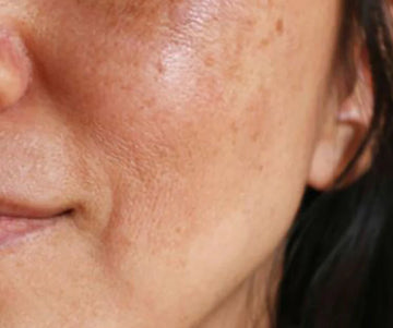 Help, I have brown spots: what should I do?